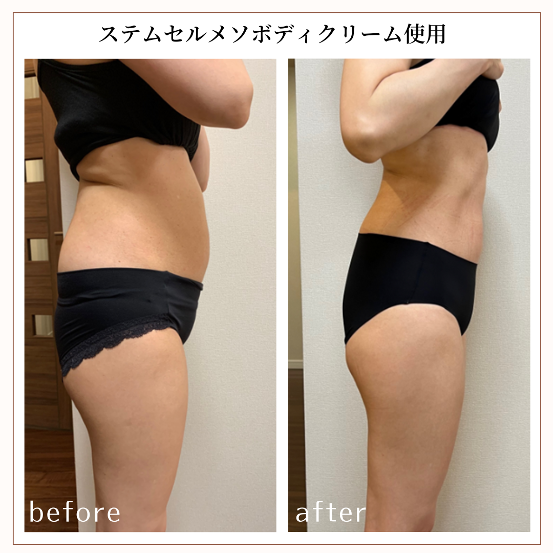 脂肪溶解注射効果⁉メソクリームとは？ ｜仙台でダイエットならベルタ